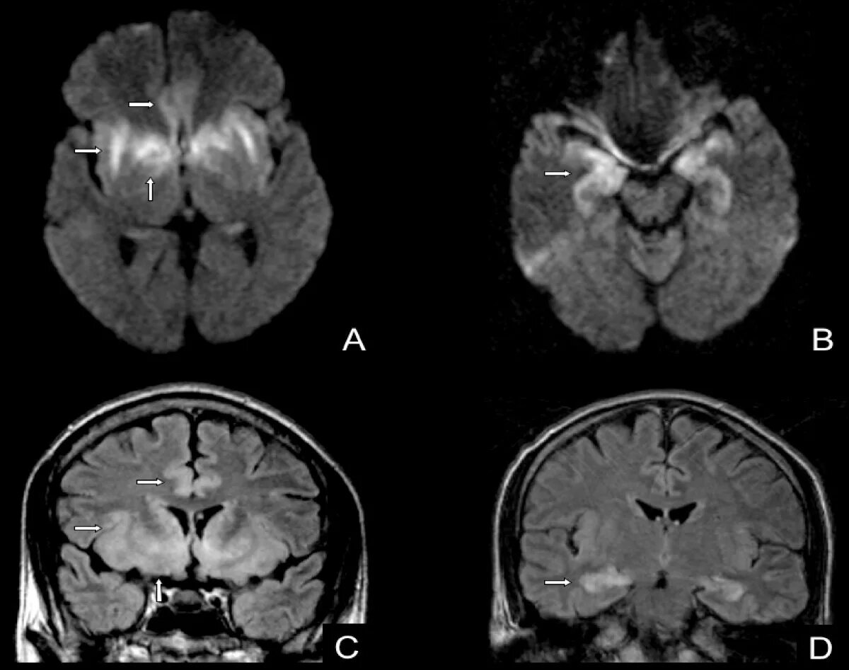 Энцефалит мозга у взрослых. Герпетический энцефалит мрт. Герпетический энцефалит кт. Энцефалит головного мозга кт. Лимбический энцефалит на кт.