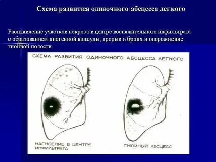 Абсцесса гнойного воспаления