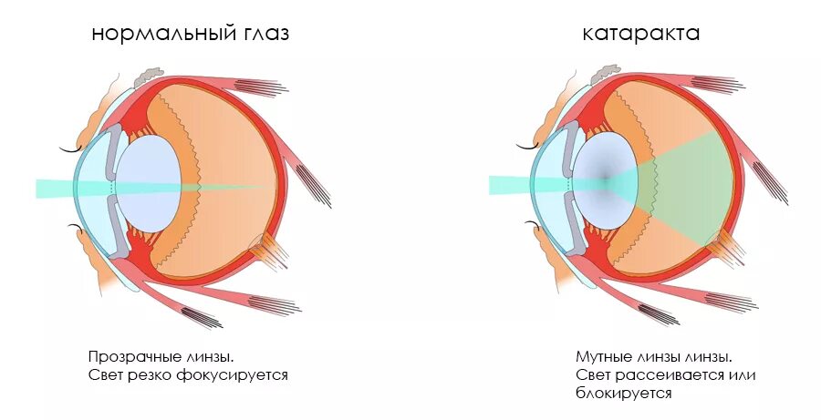 Что нельзя после операции катаракты глаза. Катаракта схема глаза. Патология хрусталика (катаракта). Катаракта глаза катаракта схема. Схема хрусталика глаза.