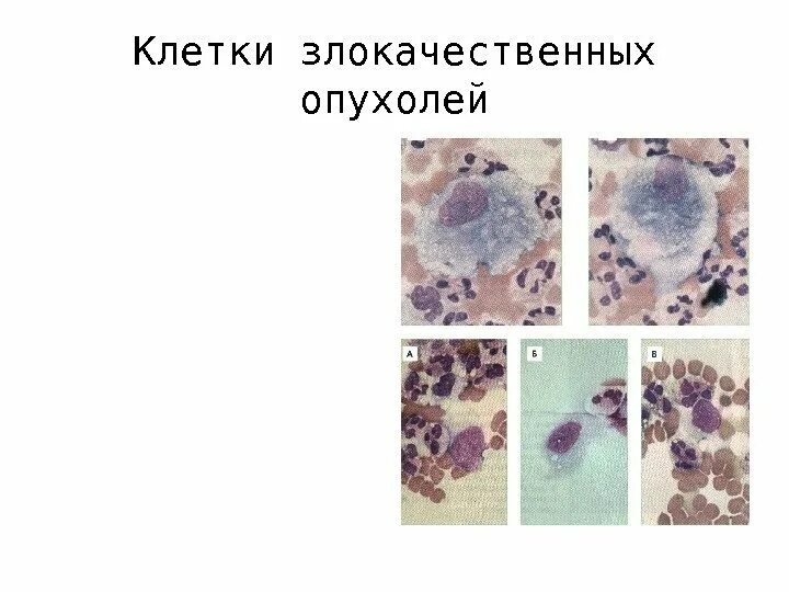 Крупноклеточная лимфома гистология. B клеточная опухоль. Крупноклеточная лимфома гистология. Дифференцировка опухолевых клеток. Диффузная b клеточная лимфома.