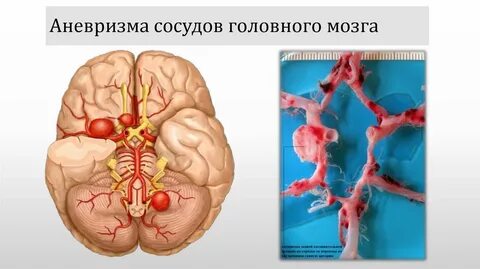 Аневризма головного последствия