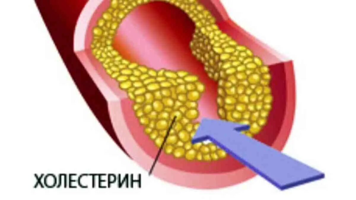 Как избавиться от холестериновых бляшек. Препараты для очистки сосудов от холестериновых бляшек. холестериновые бляшки на ногах. холестерин 7. сосуды с холестерином в мозге.