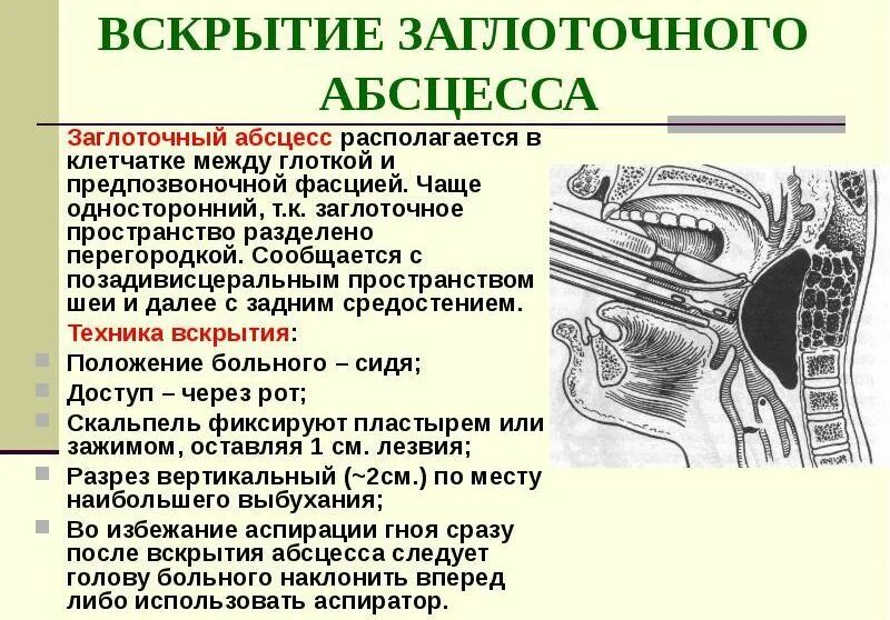 Абсцесс заглоточного пространства. Вскрытие паратонзиллярного абсцесса. Вскрытие заглоточного абсцесса. Вскрытие паратонзиллярного абцесс а.