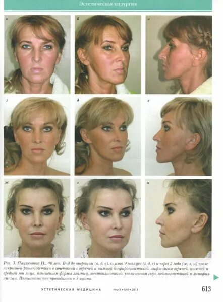 ринопластика у мошака. мошак пластический хирург владивосток. сергей мошак пластический хирург. сергей мошак пластический хирург. пластика носа реабилитация.