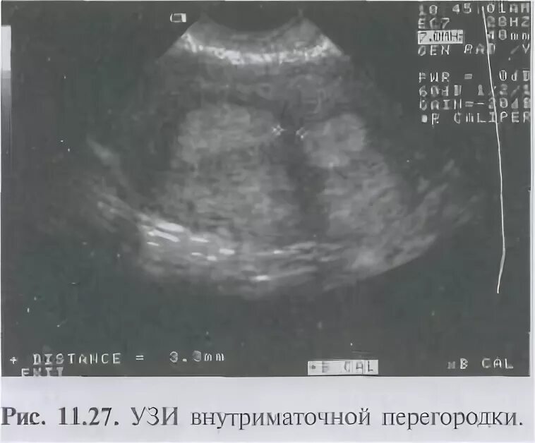 Синехии в матке на узи
