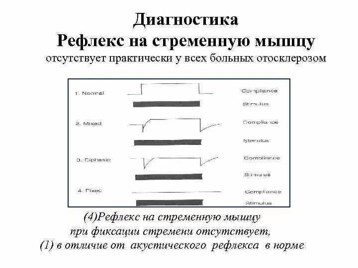 Тест распада акустического рефлекса. Аккустические реылексы при отос. Акустический рефлекс расшифровка. Акустические рефлексы при отосклерозе.