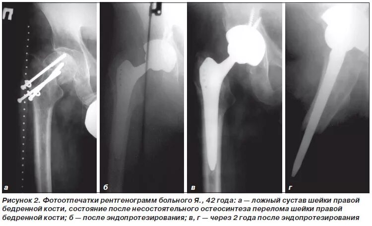 Операция шейки бедра отзывы. Ложный тазобедренный сустав рентген. Перелом шейки бедра остеосинтез. Шейка бедра перелом остеосинтез. Перелом шейки бедра остеосинтез рентген.