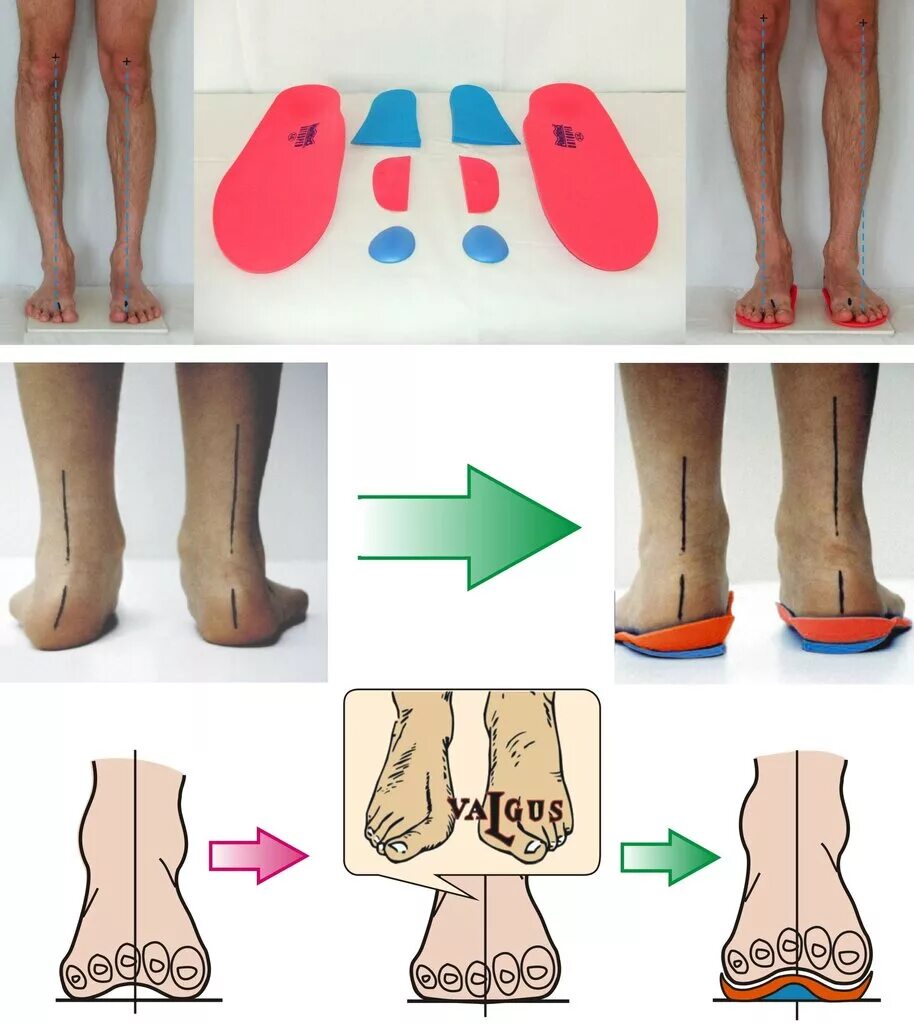Ортопедические стельки Варус вальгус. Плоскостопие вальгусная деформация. Плоскостопие вальгусная стопа. Вальгус плоскостопие стельки.