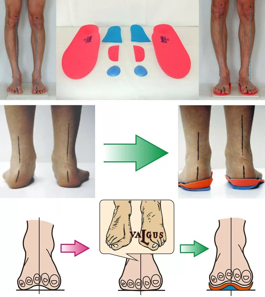 Вальгус варус плоскостопие. Плоско вальгусная деформация. Вальгусная деформация большого пальца. Халюс вальгус 2 степени. Исправляем халюс вальгус.