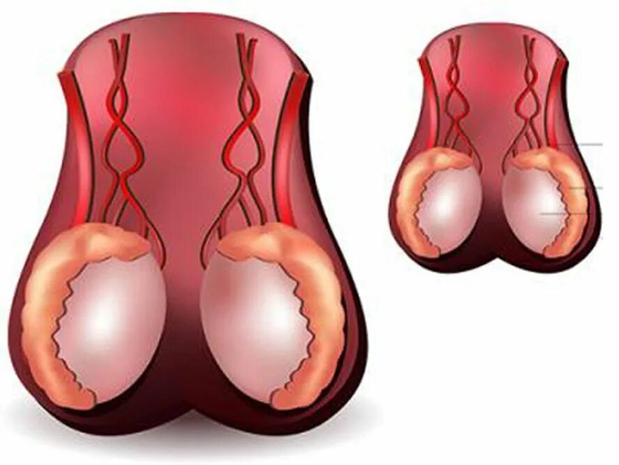 Яичко. Боли в области яичек