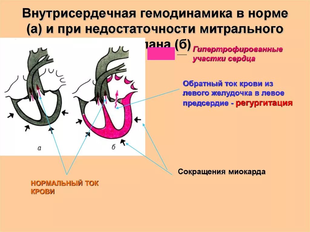 Внутрисердечная гемодинамика. Внутрисердечную гемодинамику при митральной недостаточности. Митральная недостаточность гемодинамика схема. Митральная недостаточность сердца гемодинамика. Митральная недостаточность изменение гемодинамики.