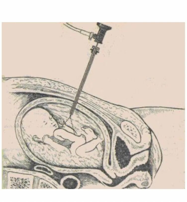 Фетоскопия метод исследования. Фетоскопия в пренатальной диагностике.