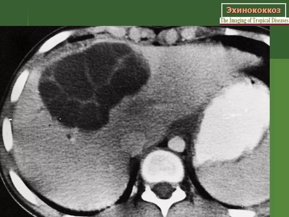 Паразитарная киста печени. Эхинококк киста печени. Эхинококкоз печени рентгенограмма. Эхинококк брюшной полости кт.