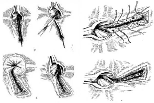 Трещина прямой. Свищ заднего прохода операция. Свич поямой кишки операция иссечение. Иссечение транссфинктерного свища. Операция иссечение свища прямой кишки.