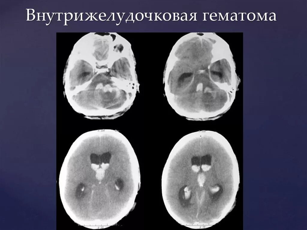 Внутрижелудочковые гематомы на кт. Внутрижелудочковое кровоизлияние кт. Внутрижелудочковая гематома головного мозга. Внутрижелудочковая гематома на кт.