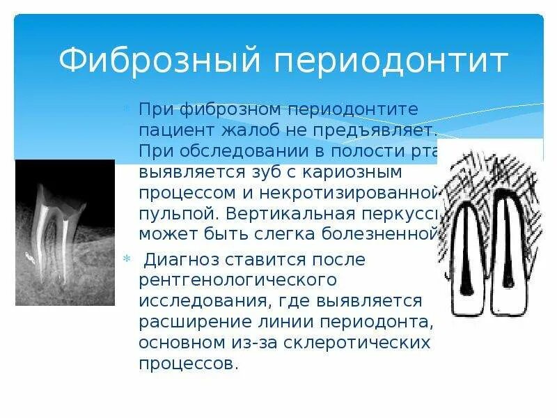 Фиброзный периодонтит. Хронический фиброзный периодонтит этиология. Хронический апикальный периодонтит перкуссия. Хронический фиброзный периодонтит термодиагностика. Хронический фиброзный периодонтит жалобы.