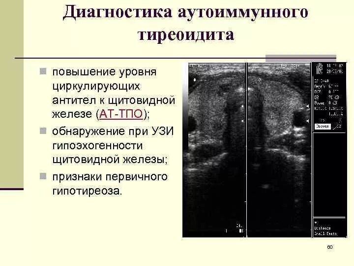 Гипотиреоз аутоиммунный по УЗИ. УЗИ картина аутоиммунного тиреоидита. Хронический аутоиммунный тиреоидит УЗИ. Аутоиммунный тиреоидит на УЗИ заключение. Щитовидная железа изменения на узи