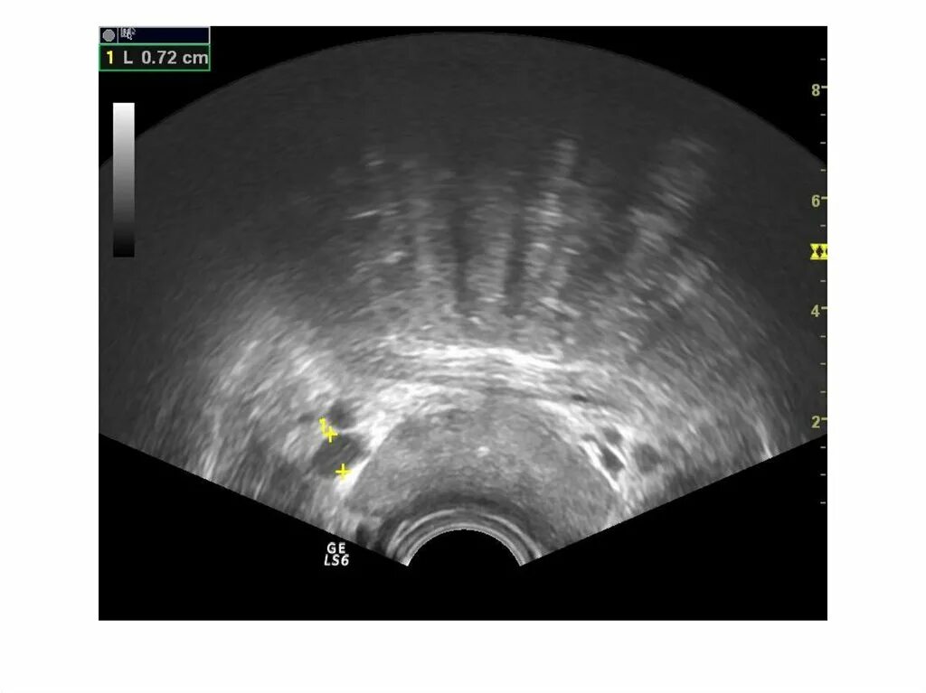 Трузи предстательной железы. Трансректальное УЗИ простаты. Трузи предстательной железы как делают