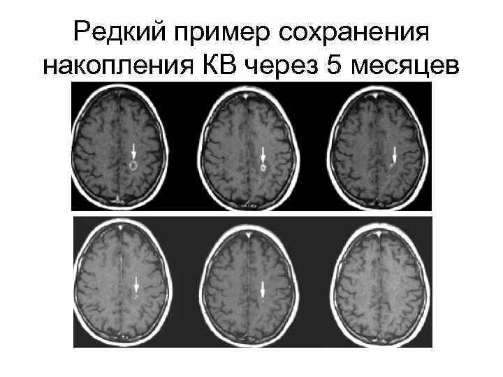 Демиелинизация головного мозга мрт. Очаги демиелинизации головного мозга на мрт. Демиелинизирующий процесс головного мозга на мрт. Демиелинизирующее заболевание ЦНС. Демиелинизация головного