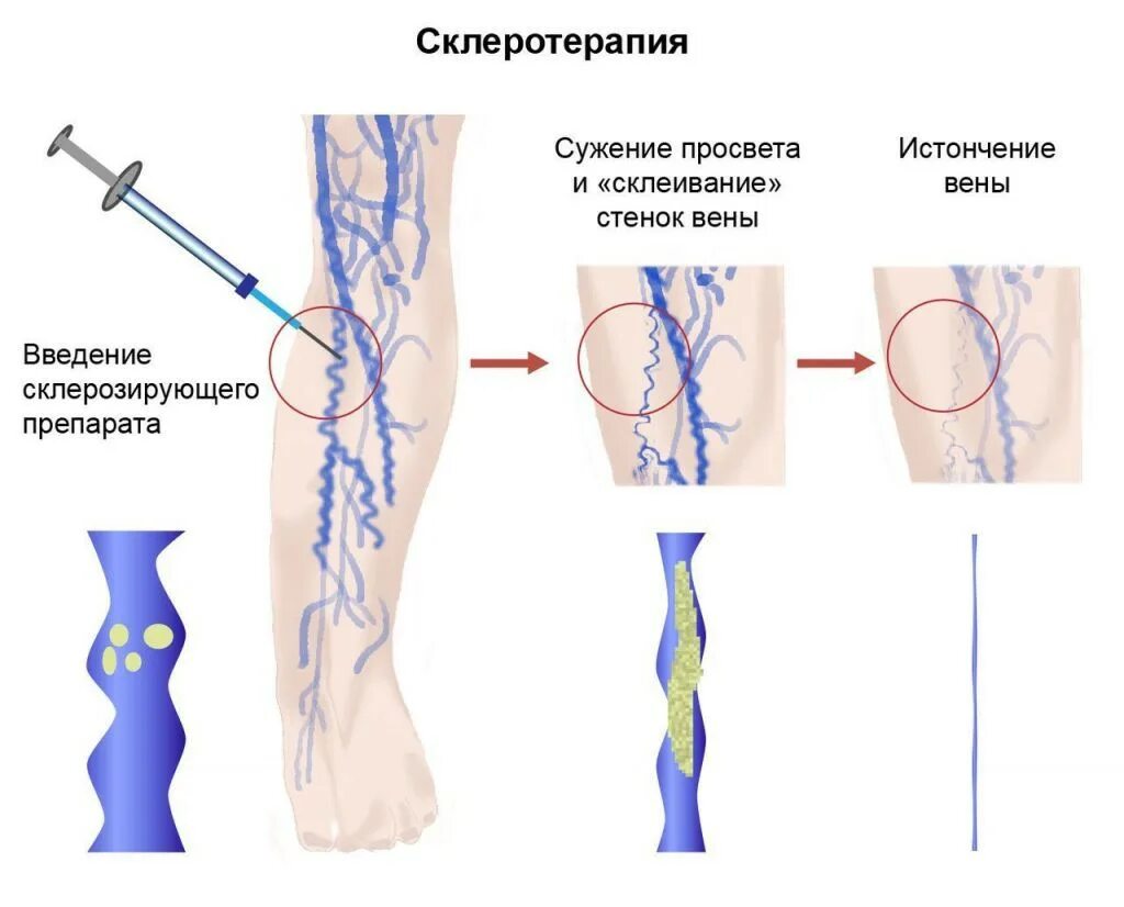 Склеротерапия подкожных вен. Пункционная склеротерапия. Компрессионная склеротерапия вен. Склерозирование притоков вены. Варикозное расширение ног препараты