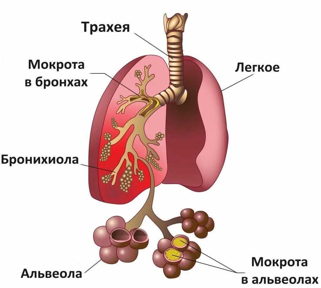 Мокрота при воспалении