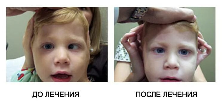 Операция по исправлению косоглазия у детей. Амблиопия (синдром ленивого глаза). исправление косоглазия. косоглазие у детей до и после операции. амблиопия у детей.