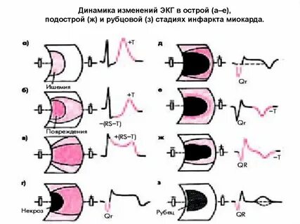 Экг признаком острейшей стадии инфаркта миокарда является
