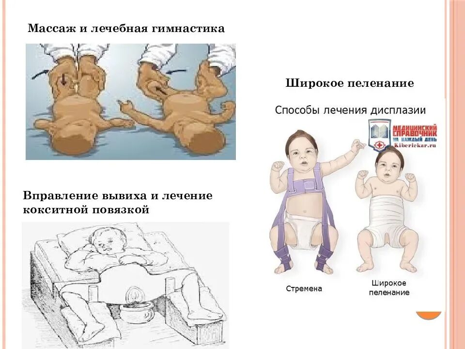 Пеленание при дисплазии. Дисплазия тазобедренных суставов широкое пеленание. Техника широкого пеленания при дисплазии тазобедренных суставов. Пеленание новорожденного при дисплазии тазобедренных суставов. Пеленать при дисплазии тазобедренного сустава.