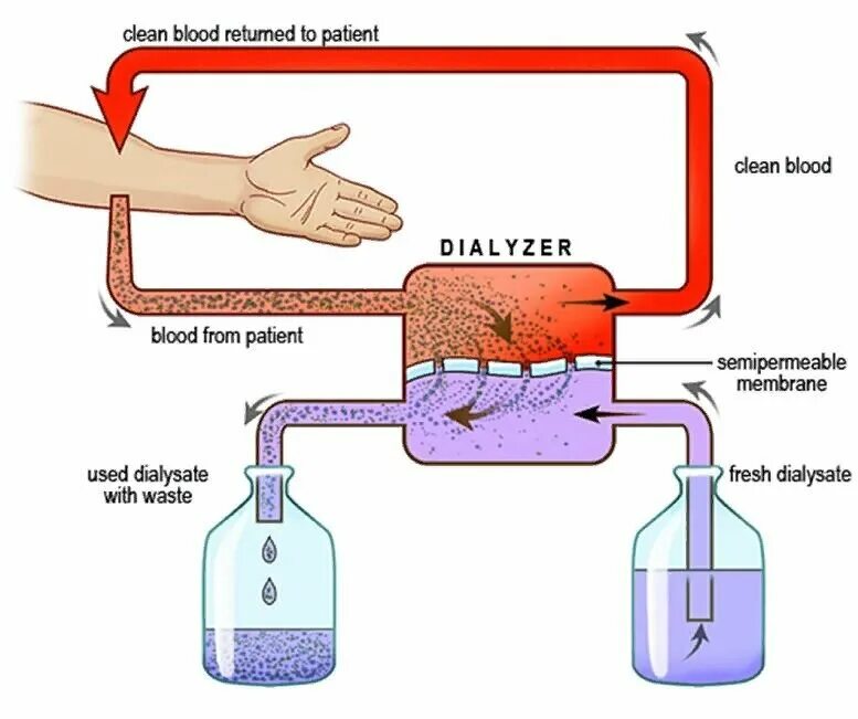 Диализ белков. Гемодиализ схема проведения. Принцип работы аппарата для диализа крови. Схема диализа крови. Принцип действия искусственной почки.