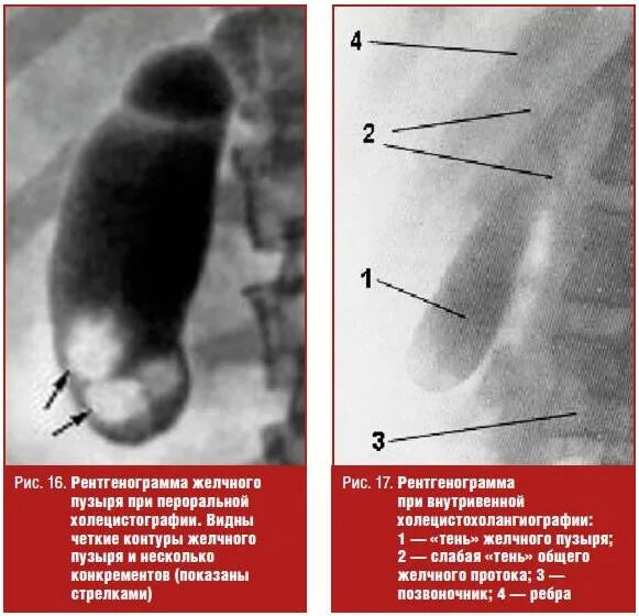 Описание желчного пузыря. Рентген исследование желчного пузыря. Камни в жёлчном пузыре холецистография. Конкременты желчного пузыря рентген. Рентгенотрицательные камни желчного пузыря.