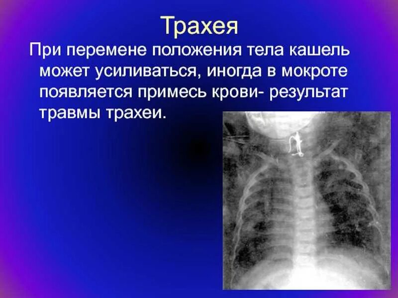 Инородные Тела Трахеи Бронхов