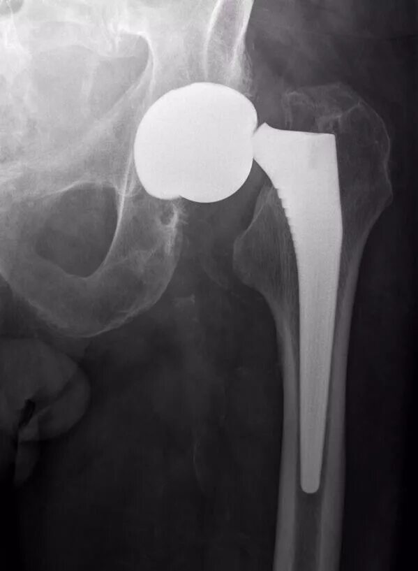Осложнения после эндопротезирования тазобедренного. Вывих эндопротеза тазобедренного сустава рентген. Подвывих эндопротеза тазобедренного. Aesculap эндопротезы тазобедренного сустава. Эндопротезирование тазобедренного сустава рентген.
