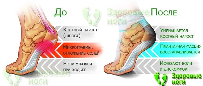 Соль в пятках симптомы