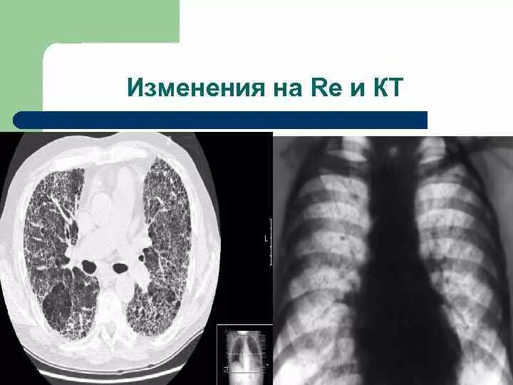 Признаки интерстициального изменения легких. Интерстициальная пневмония на кт. интерстициальные болезни легких. интерстициальные изменения в легких что это. интерстициальные болезни легких кт.