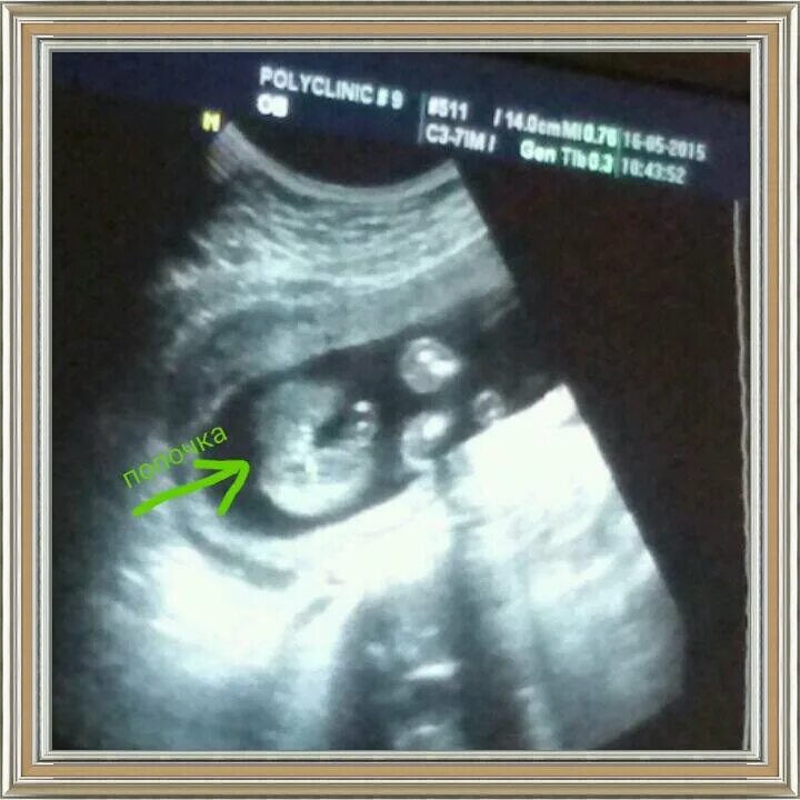 Узи мальчика на 20 неделе мальчик. Узи девочке 19 недель. Узи девочке 19 недель. Узи девочке 19 недель. Узи 19 недель беременности девочка.