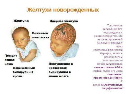 Сколько длится желтушка