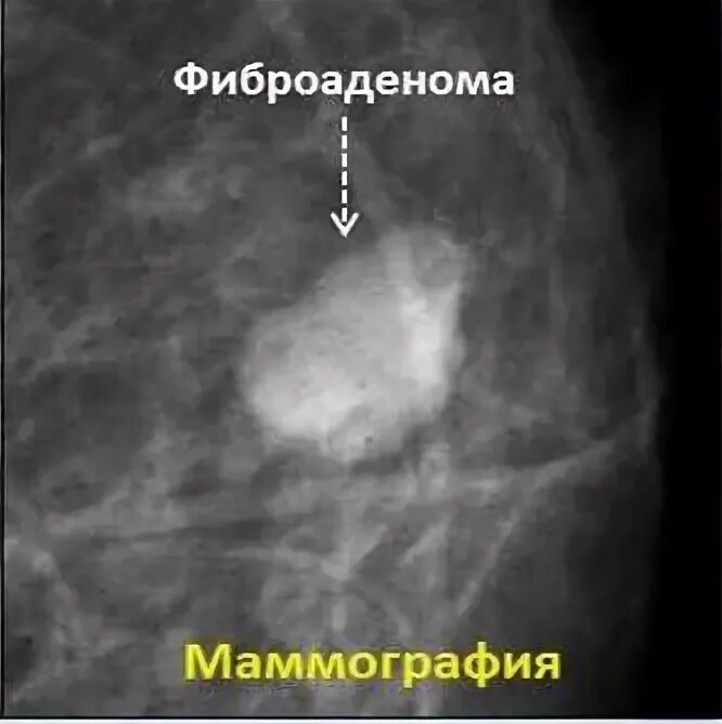 Диффузный фиброаденоматоз что это. Фиброаденома молочной железы маммография. листовидная фиброаденома. фиброаденоматоз молочной железы на маммографии.