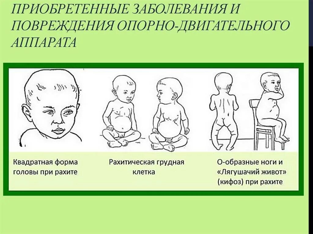 Грудная клетка рахит 2 года. Рахит 2 степени у грудничка признаки. Рахит 1 степени симптомы у новорожденных. Форма головы при рахите у грудничка.