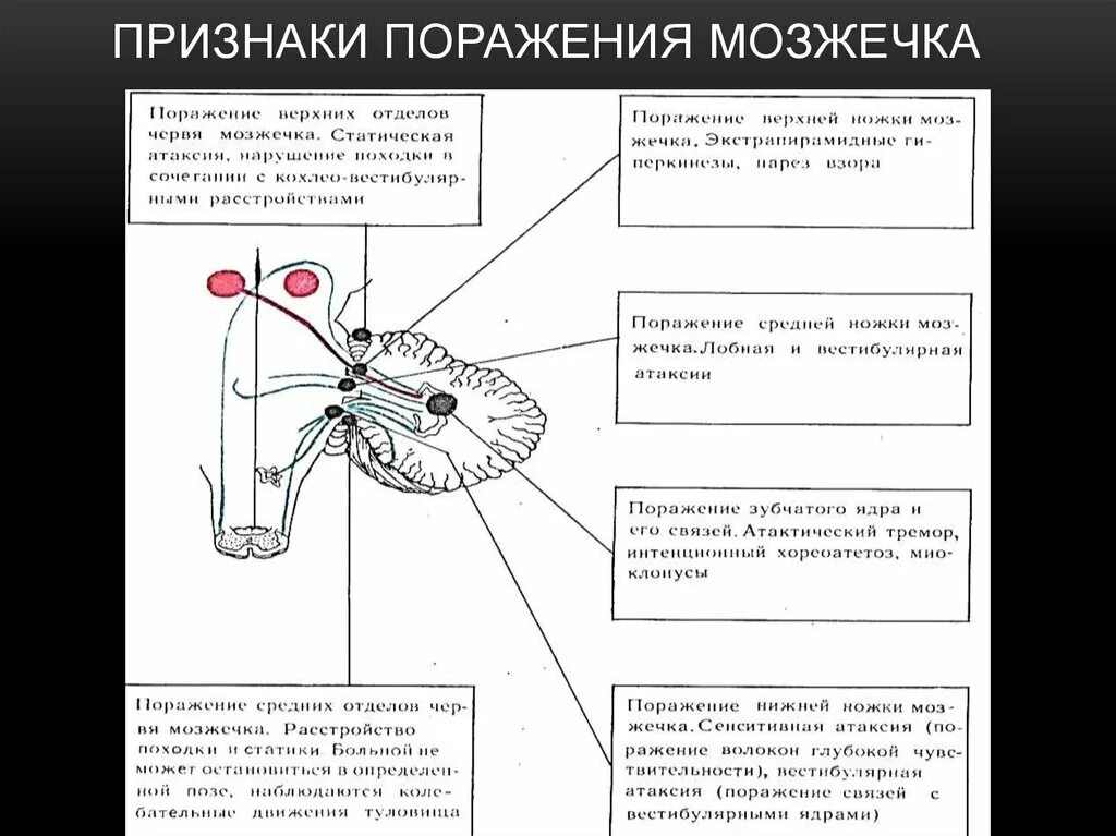 Нарушение функции мозжечка. Синдромы повреждения мозжечка. Поражение мозжечка неврология. Симптоматика поражения мозжечка. Симптомы поражения червя мозжечка неврология.