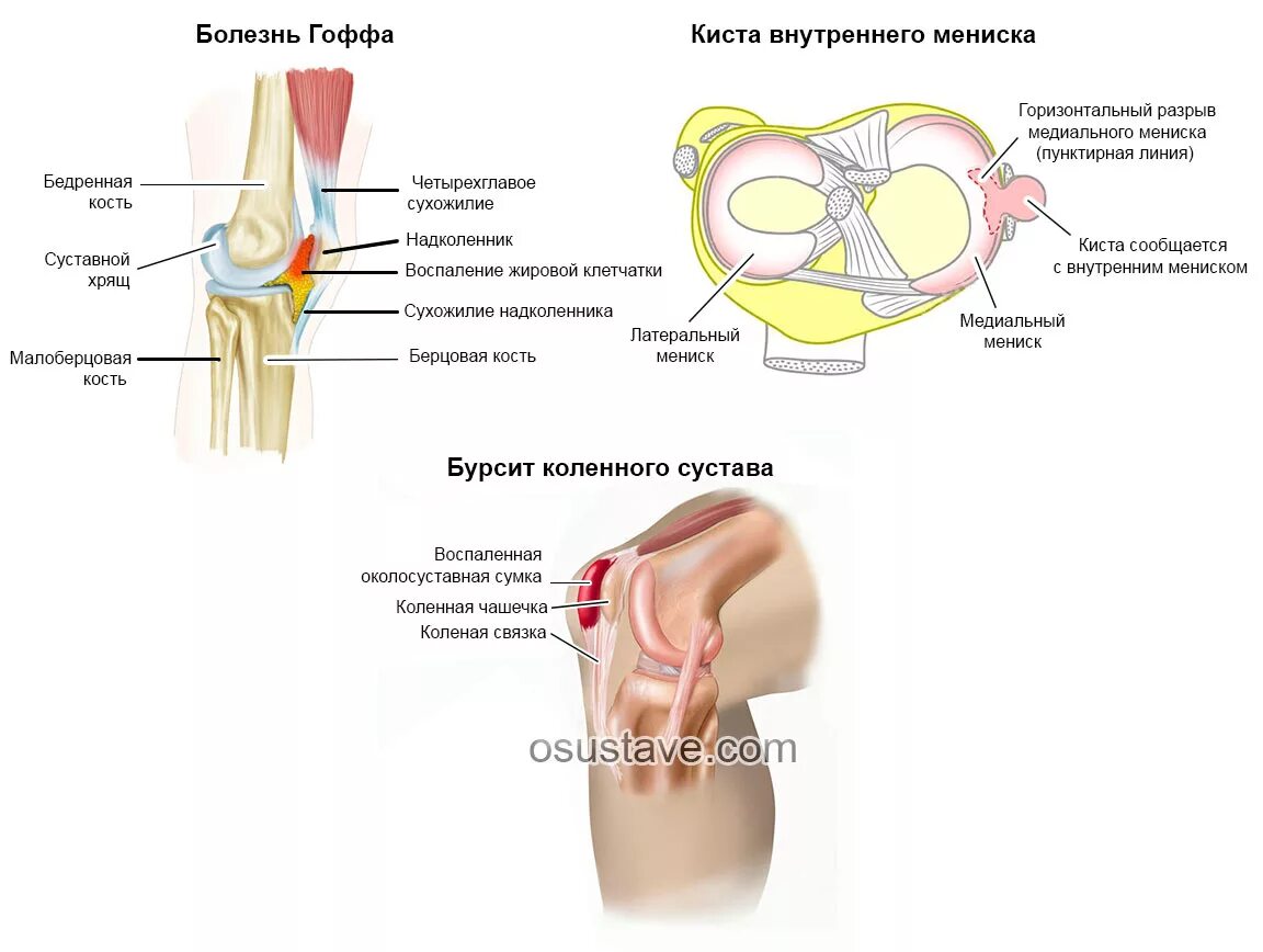 Боль под коленкой спереди сбоку с внутренней стороны. Боль в колене сбоку с внутренней стороны при сгибании. Коленный сустав сбоку сгиб.