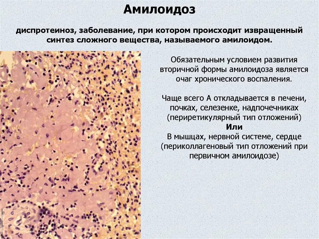 Морфологические изменения болезни. Амилоидоз печени патанатомия. Амилоидоз почки вид дистрофии. Амилоидоз печени патологическая анатомия. Патогенез амилоидоза патанатомия.