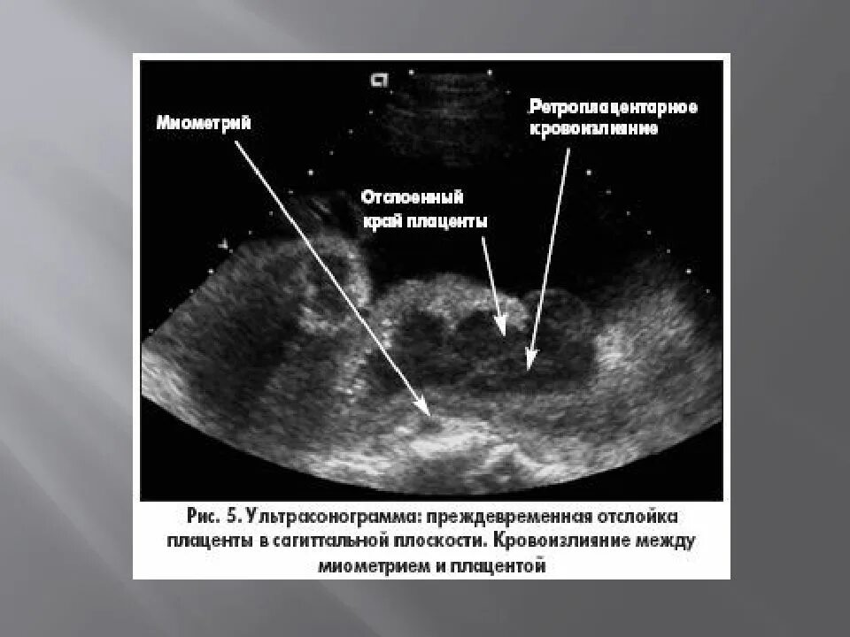 Гематома 6 недель. Преждевременная отслойка нормально расположенной плаценты УЗИ. Отслойка нормально расположенной плаценты УЗИ. Преждевременная отслойка плаценты УЗИ. Ультразвуковые признаки отслойки плаценты.