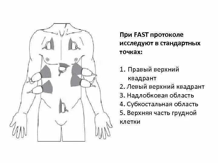 Fast протокол УЗИ. Ургентная сонография при травме fast-протоколы. Фаст протокол УЗИ при травме. Fast протокол при травме. Fast протокол