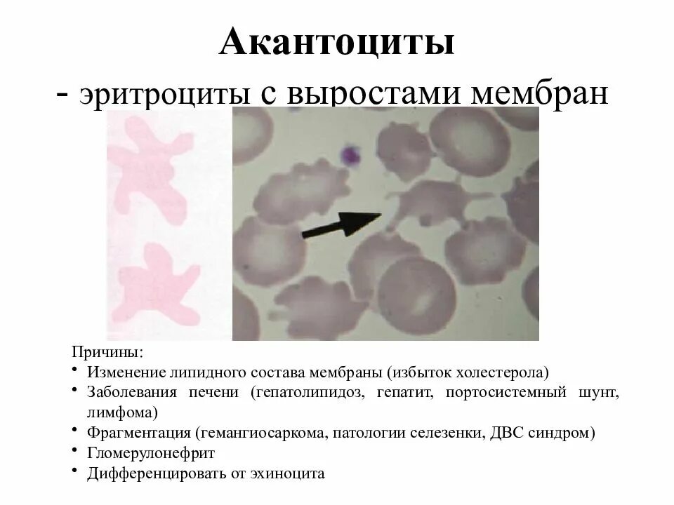 Формы встречающихся эритроцитов. Эритроциты в крови акантоциты. эритроциты шиповатой формы. наследственный акантоцитоз. патологические формы эритроцитов.