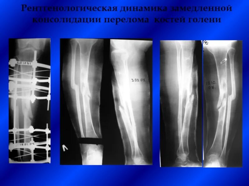 Что такое консолидация перелома. Консолидирующий перелом малой берцовой кости. Консолидация кости при переломе. Консолидированный перелом голени. Консолидирующийся перелом бедренной кости.