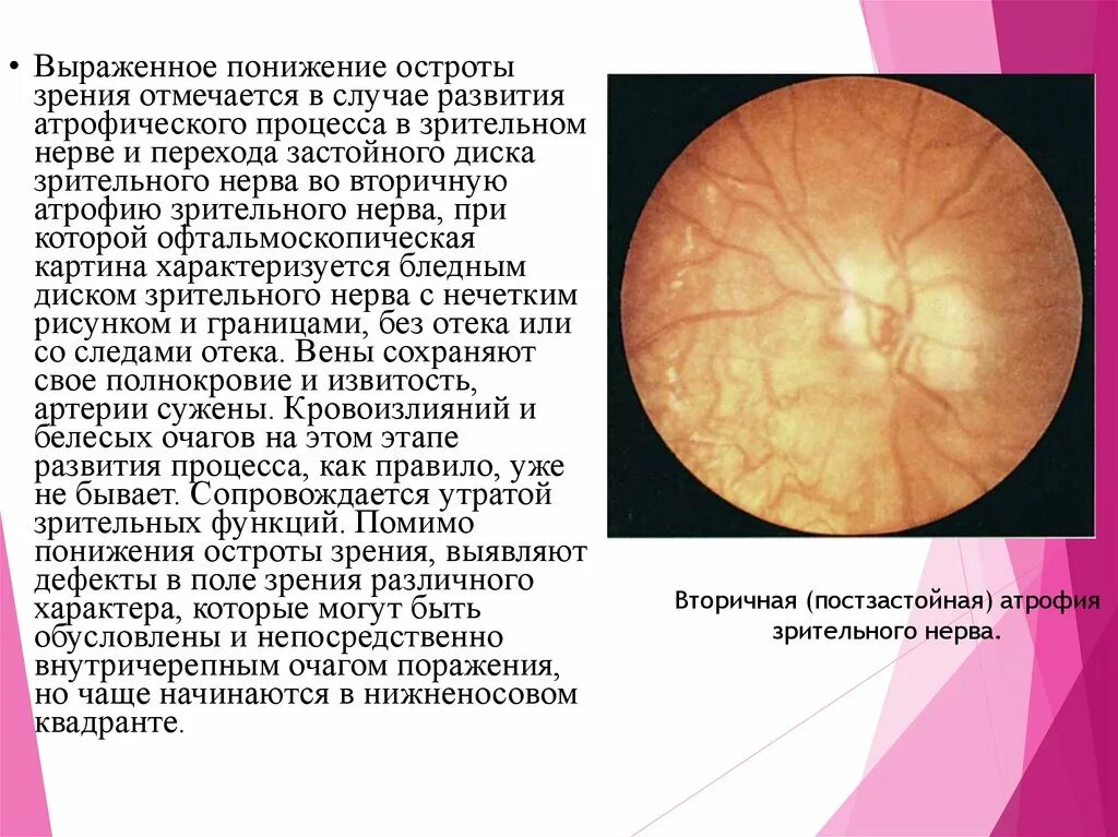 Омертвление зрительного нерва. Постзастойная атрофия диска зрительного нерва. Нисходящая атрофия зрительного нерва мрт. Застойный диск зрительного нерва зрительного нерва. Атрофия латынь