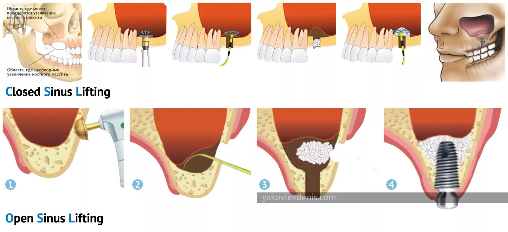 Синус-лифтинг (костная пластика, остеопластика). Крестальный синус-лифтинг. Синус-лифтинг (костная пластика, остеопластика) закрытый. Остеотомный синус лифтинг. Синус десны
