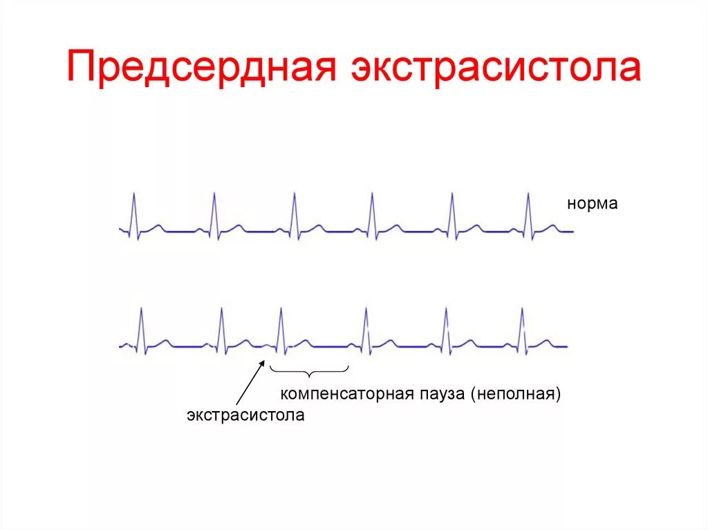 Экстрасистолия предсердий на ЭКГ. Предсердная экстрасистолия на ЭКГ. Предсердная экстрасистолия на экu. Экстрасистола предсердия на ЭКГ. Блокированные экстрасистолы