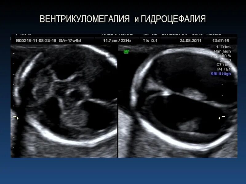 Ксс у плода. Вентрикуломегалия плода на УЗИ. Гидроцефалия у плода на УЗИ. Гидроцефалия УЗИ головного мозга.