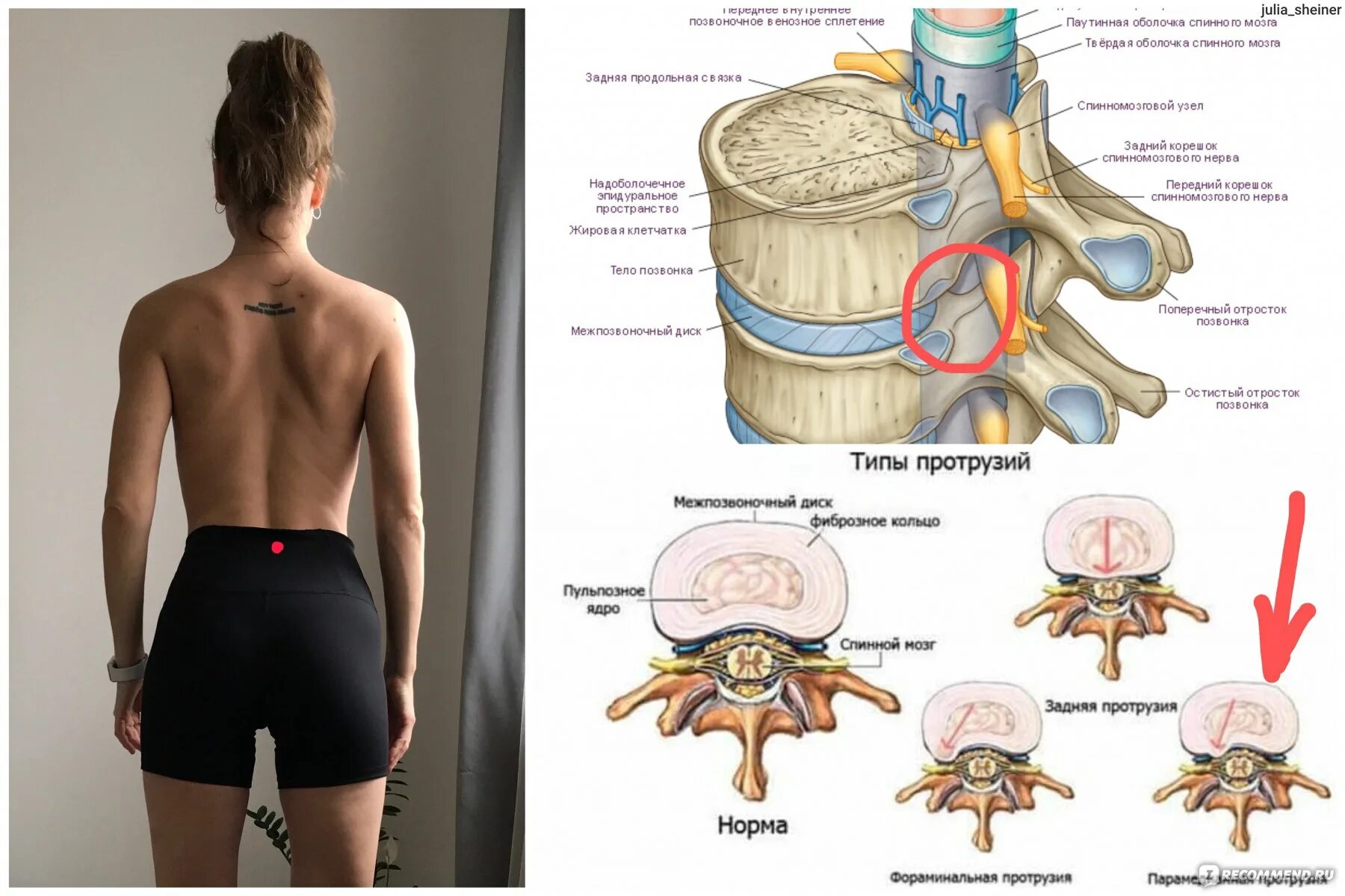 Спинной форум. Протрузии дисков позвоночника поясничного и шейного отдела. Грыжи и протрузии позвоночника. Протрузии дисков с4-th1. Поясничный отдел позвоночника.